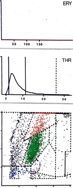 LMNE matrix of a type III (combined type of infection and abrasion) with a cluster in the area of the neutrophil leukocytes and a second cluster in the NOISE area as well as no peak in the erythrocyte field in a 83-year old female patient with a periprosthetic joint infection of a hip arthroplasty. The measured cell count was 2940 cells/μL with 79.6% PMN.