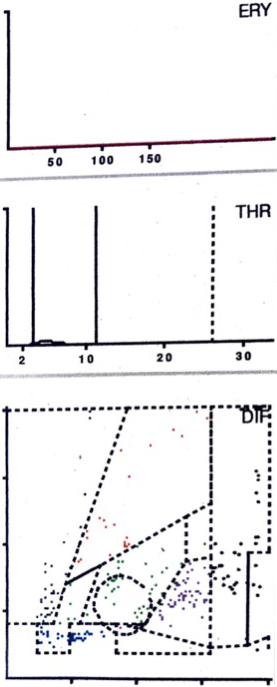 LMNE matrix of a type IV (indeterminate type) with no obvious data point clusters or increase in cell types or particles in a 62-year old female patient. The measured cell count was 400 cells/μL with 22.5% PMN.