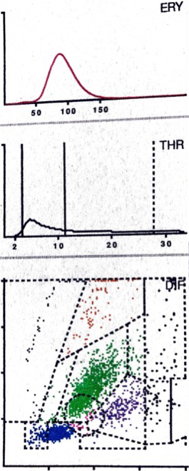 LMNE matrix of a type V (hematoma) 75-year old female patient with a hematoma 6 weeks after knee arthroplasty. There is a cluster in the field of the lymphocytes and another clear cluster in the fleld of the neutrophils and a peak in the erythrocyte field. The measured cell count” was 10,120 cells/μL with 59.2% PMN.