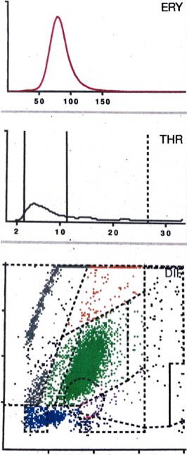 LMNE matrix of a type VI (combined type II of hematoma and infection) 5 weeks after implantation of a hip arthroplasty with a cluster in the area of the neutrophil leukocytes and increases in the other areas of the white blood cells as well as a peak in the erythrocyte field in a 72 old female patient with an early periprosthetic joint infection. The measured cell count was 15200 cells/μL with 84.4% PMN.
