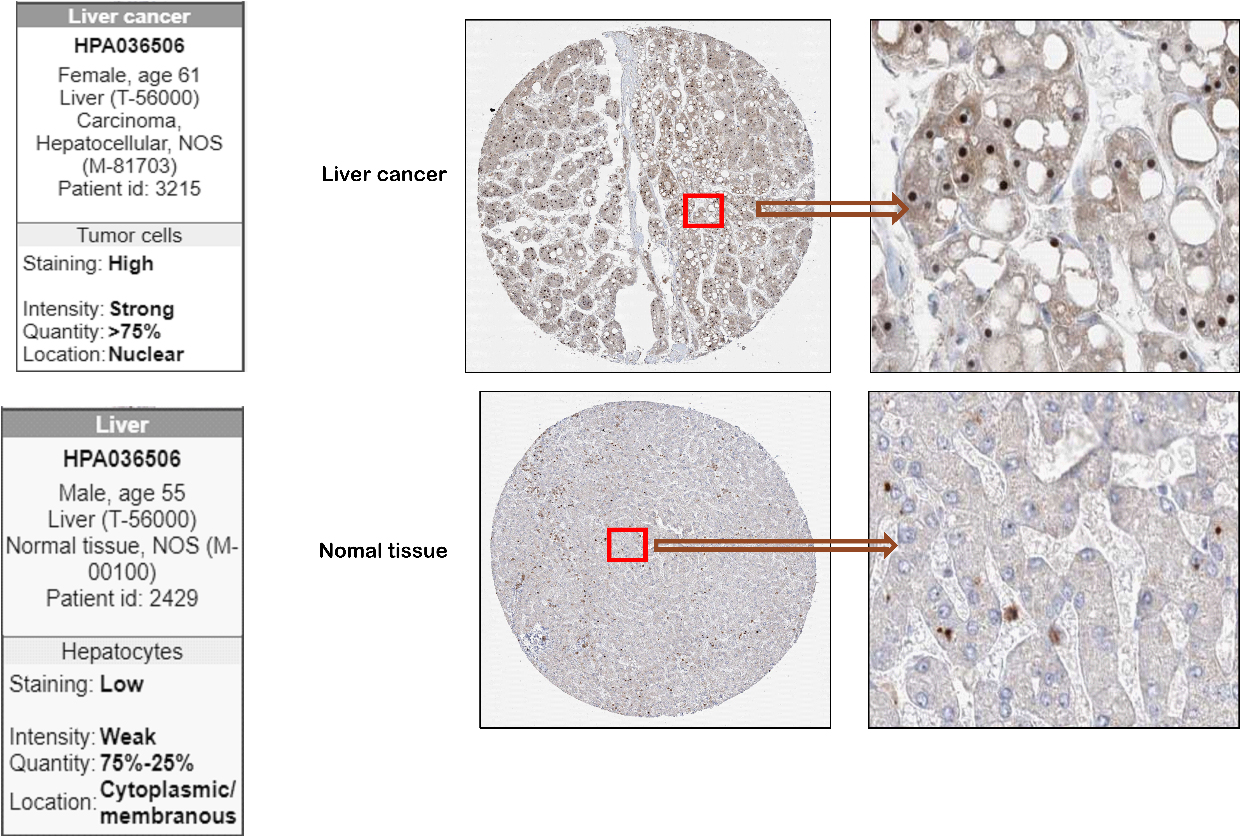 Representative images of NOP16 expression in LIHC tissues and normal tissues. Images of immunohistochemistry staining for LIHC and normal tissues were collected with HPA. The greater the antigen content (representing the level of protein expression) and the higher the distribution density, the stronger the positive result color rendering. According to the degree of colorrendering of positive markers, they are classified as: blue, negative; light yellow, weaklypositive; brown, moderately positive; and dark brown, strongly positive.