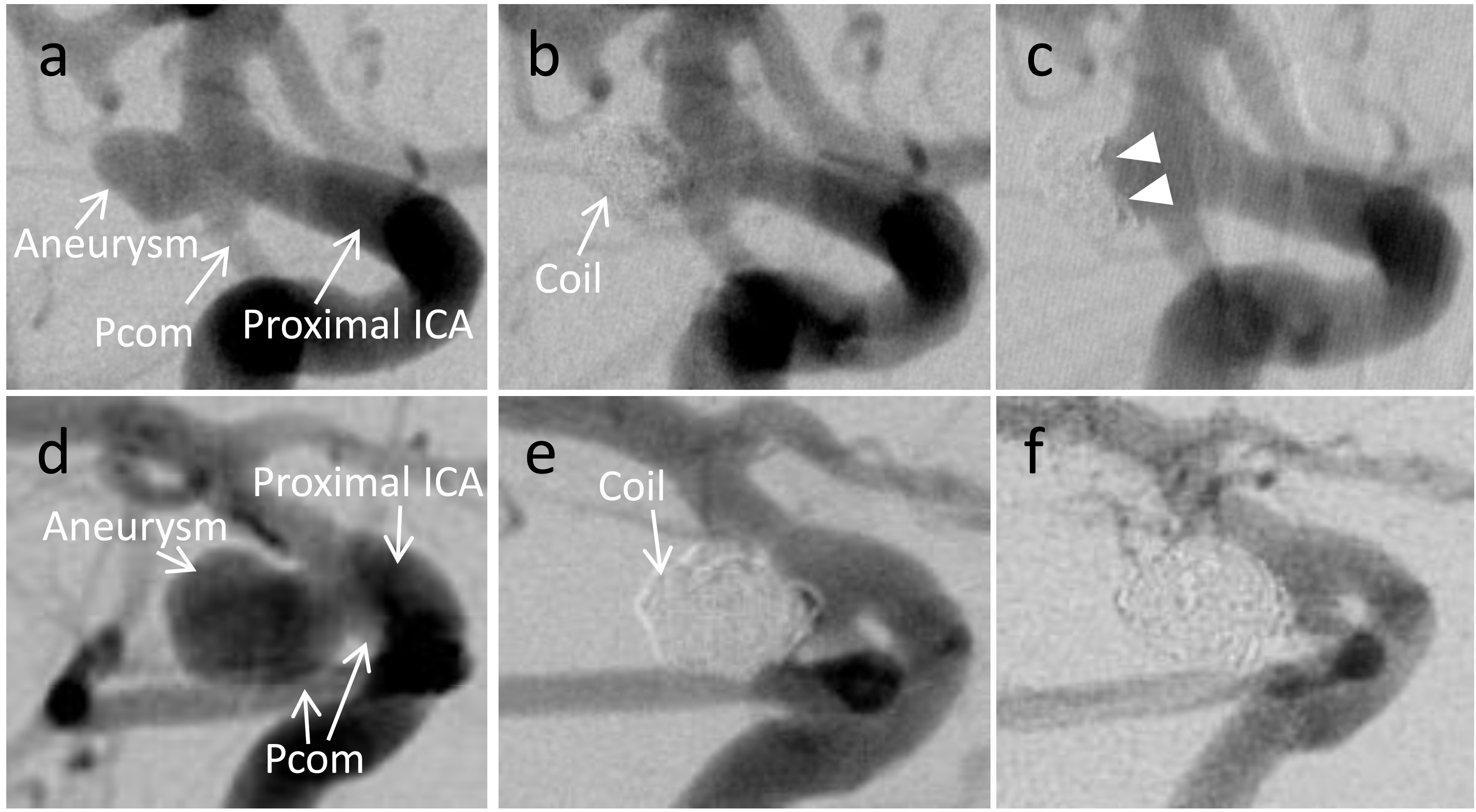 Representative cases. (a): Pretreatment right internal carotid artery (ICA) angiography, lateral view, shows an unruptured posterior communicating artery (Pcom) aneurysm. Velocity ratio and flow rate of the Pcom are 0.397 and 47.9 mL min-1, respectively. (b): Right ICA angiography immediately after endovascular treatment shows sufficient occlusion with a small neck remnant, and the volume embolization ratio is 25.0%. (c): Right ICA angiography 1 year after coil embolization reveals an obvious aneurysm recurrence due to coil compaction (arrowheads). (d): Right ICA angiography, right oblique view, before treatment demonstrates an unruptured Pcom aneurysm with abundant Pcom flow. Velocity ratio and flow rate of the Pcom are 0.793 and 111.8 mL min-1, respectively. (e): Post-treatment right ICA angiography shows the occluded aneurysm with a volume embolization ratio of 24.2%. (f): ICA angiography 1 year after treatment reveals no aneurysm recurrence. 