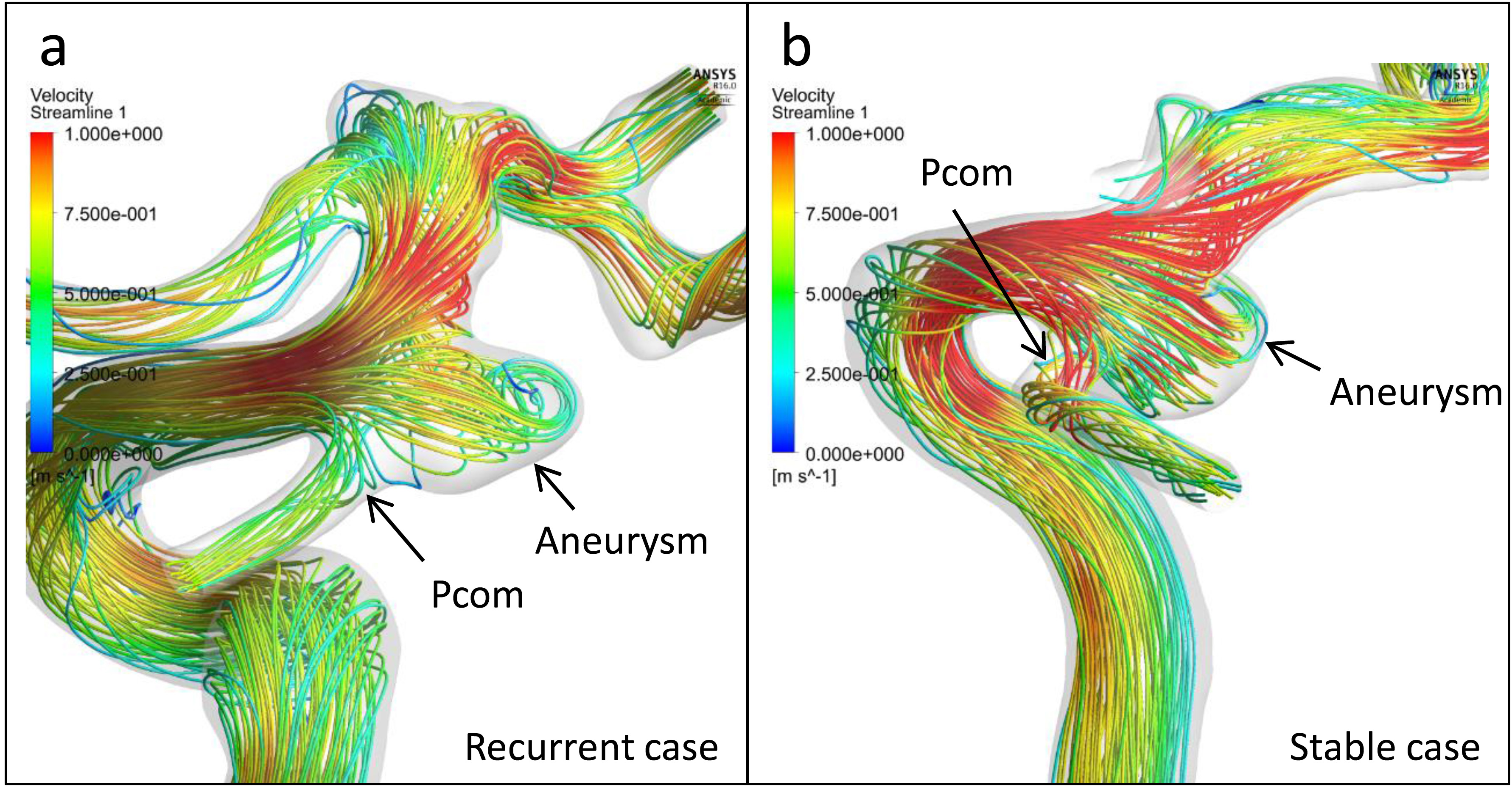 Streamlines of the representative cases. (a): Streamlines of the pretreatment vascular model of the recurrent case in Fig. 2 show that the velocities of Pcom and ICA were almost 25 to 50 cm/s and 75 to 100 cm/s, respectively. These results correspond to the velocity ratio of 0.397. (b): Streamlines of the representative stable case in Fig. 2 show that the velocities of Pcom and ICA were 75 to 100 cm/s and almost 100 cm/s, respectively, which were consonant with the velocity ratio of 0.793.