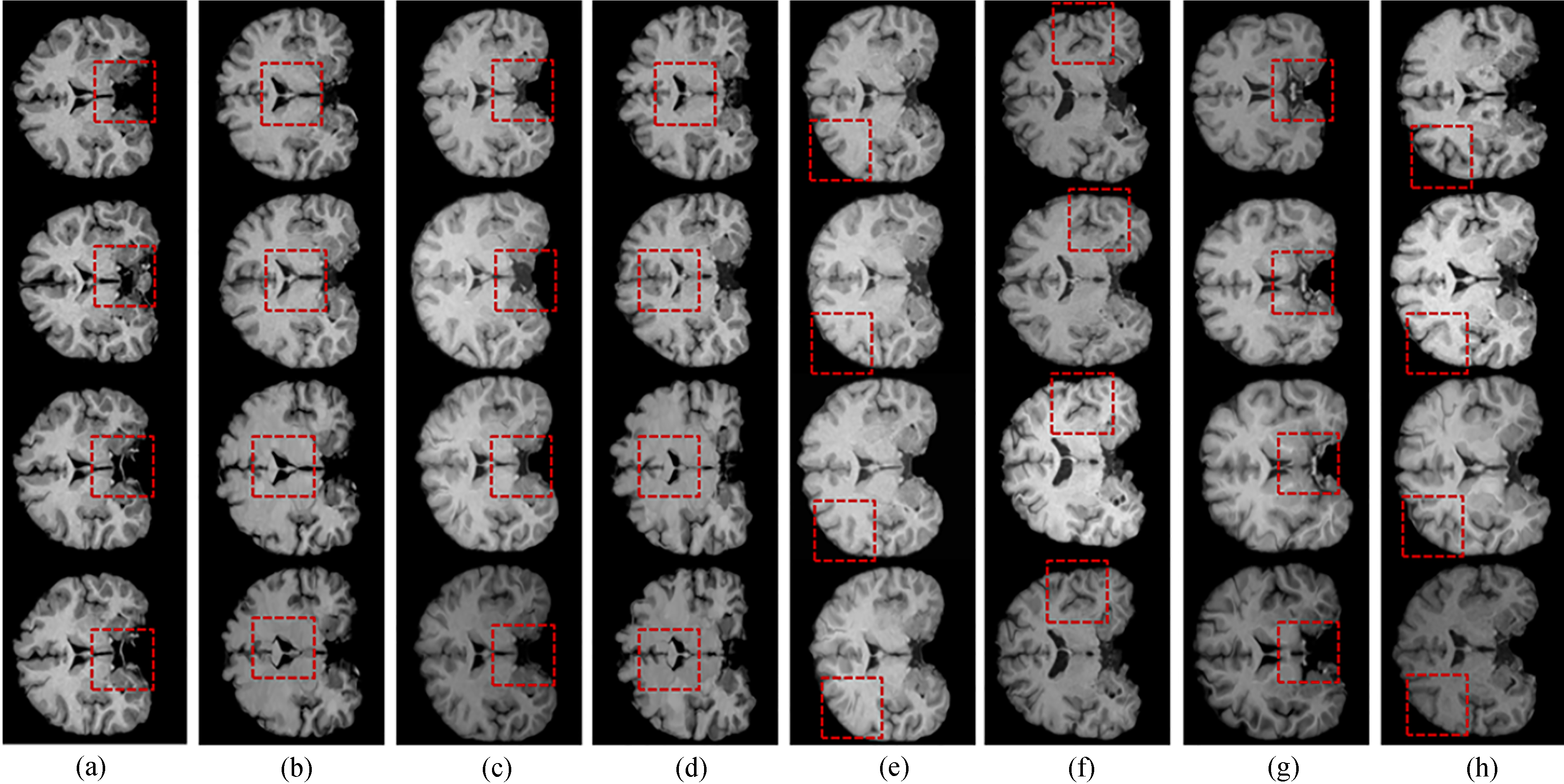 (a)–(h) are 1–8 sets of data respectively. The first row is the reference image. The second row is floating image. The third row is the result image using this improved differential Demons algorithm. The fourth row is the result image using original algorithm of differential Demons. The red dashed represents the difference of the same parts.