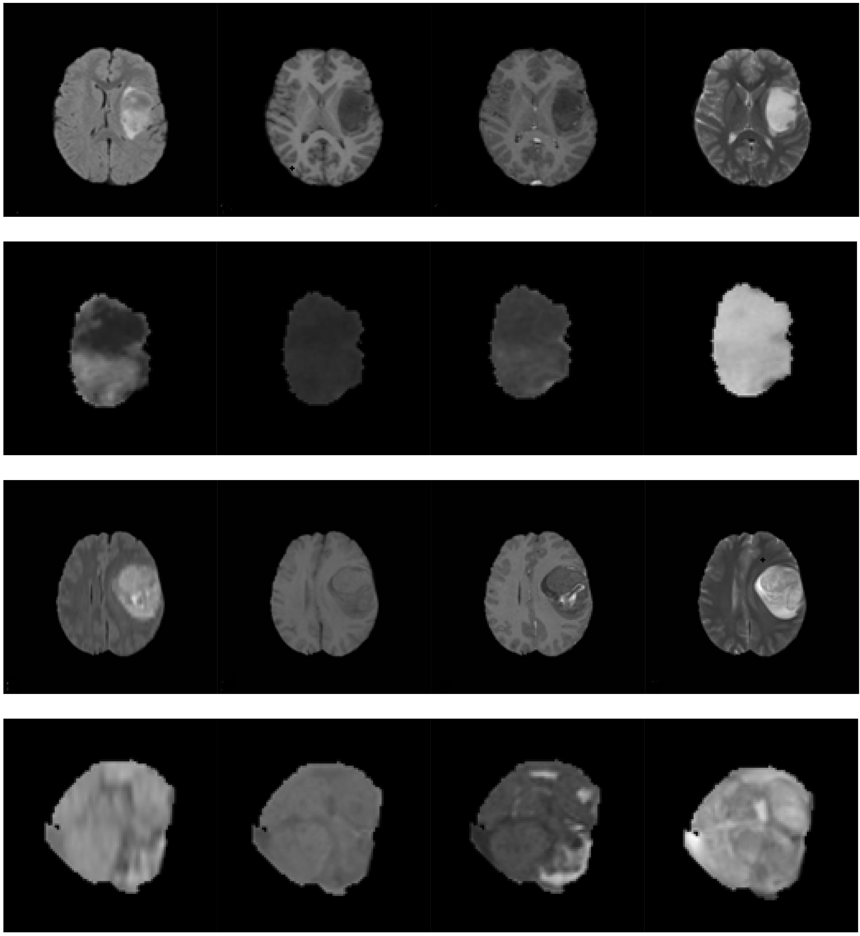 Multi-sequence MRIs of the low grade glioma and high grade glioma. The first through last rows are as follows: (1) the multi-sequence MRIs of the low grade glioma; (2) the tumor region extracted from the images in the first row; (3) the multi-sequence MRIs of the high grade glioma; and (4) the tumor region extracted from the images in the third row. The first through last columns are as follows: FLAIR sequence, T1-w sequence, T1-wc sequence, and T2-w sequence, respectively.