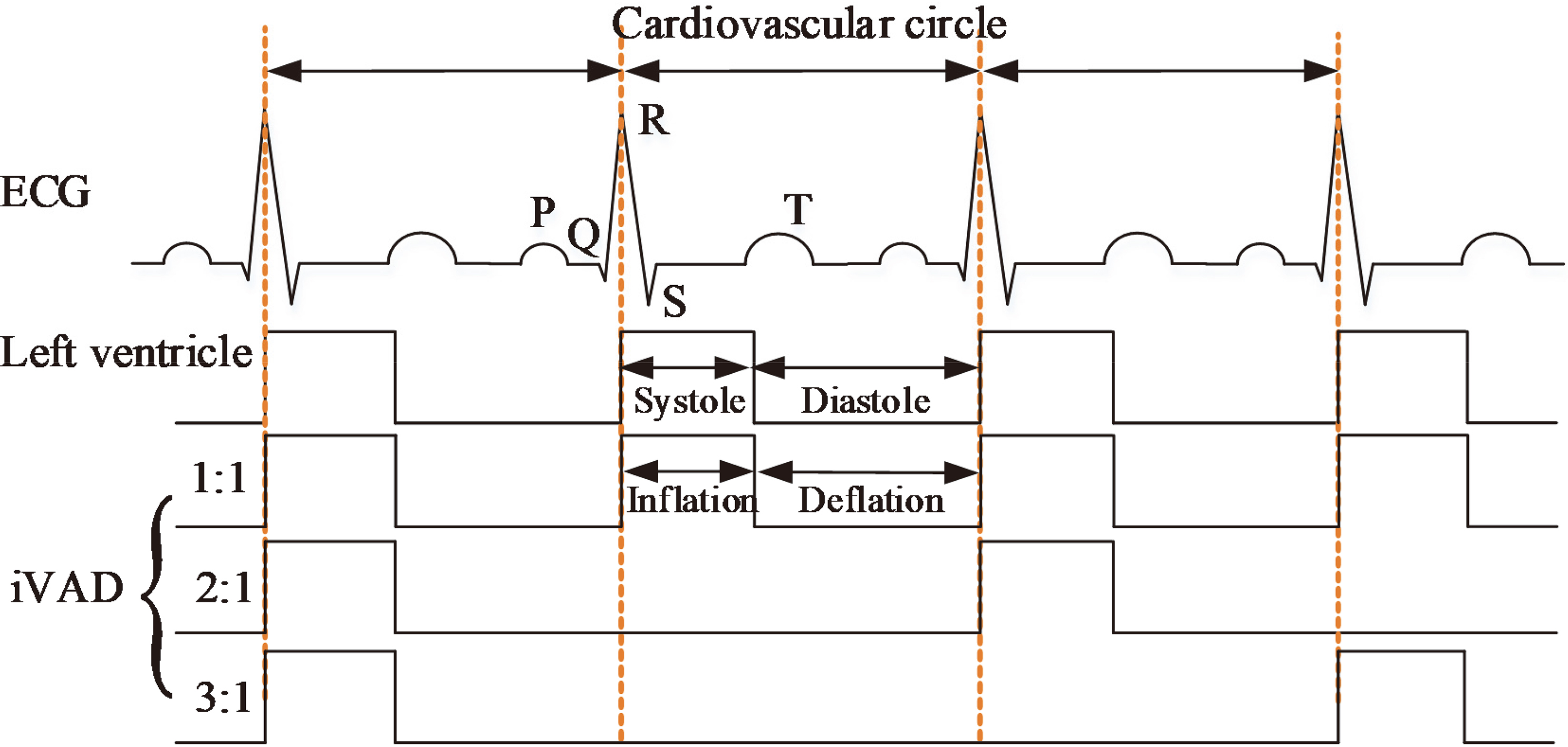 Illustration of the pulsatile rhythm of the left ventricle and the intra-ventricular assist device.