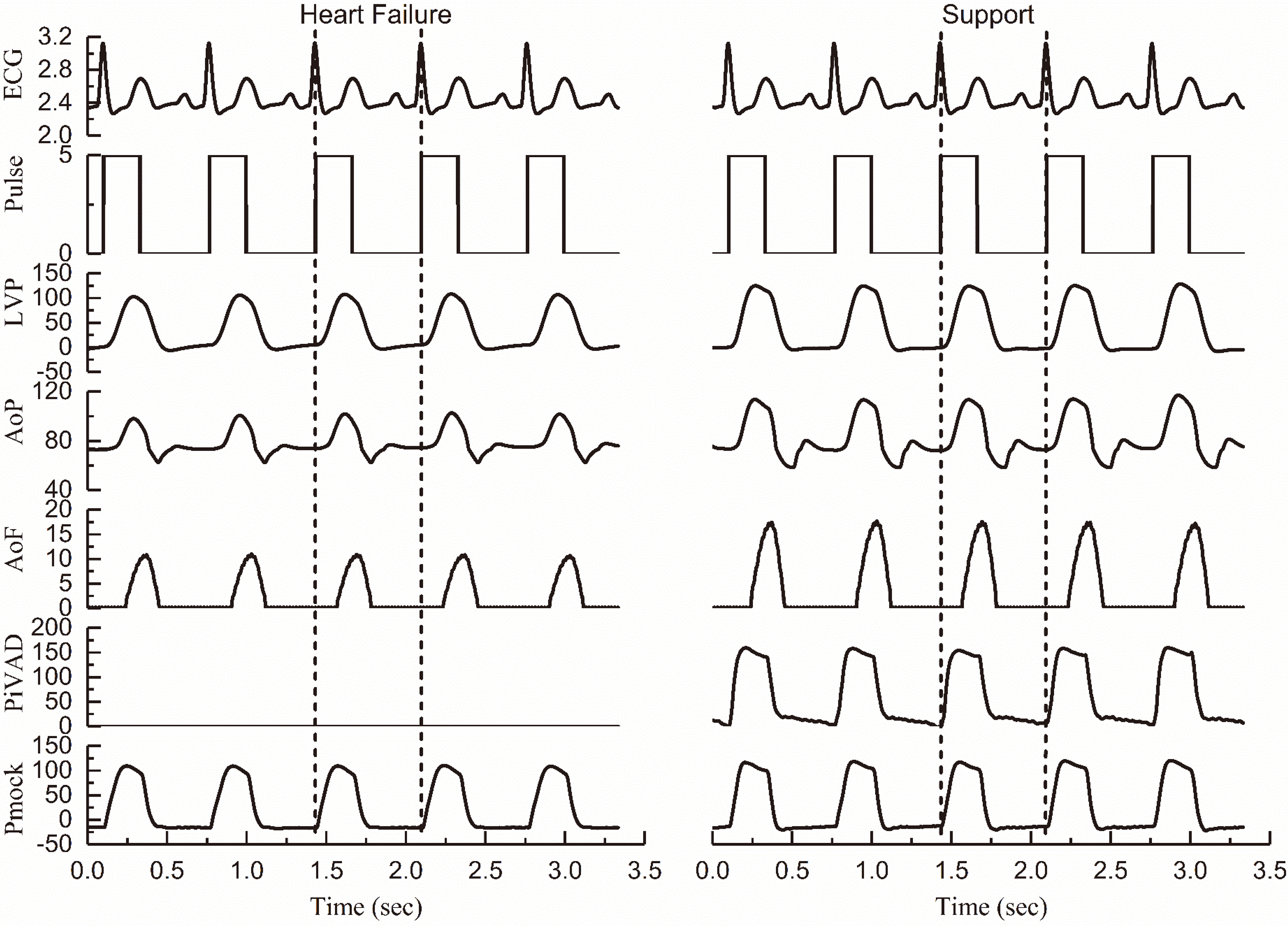 Comparison of the hemodynamics of failure heart and an iVAD support (ECG: V; Pulse: V; LVP: mmHg; AoP: mmHg; AoF: L/min; PiVAD: mmHg; Pmock: mmHg).