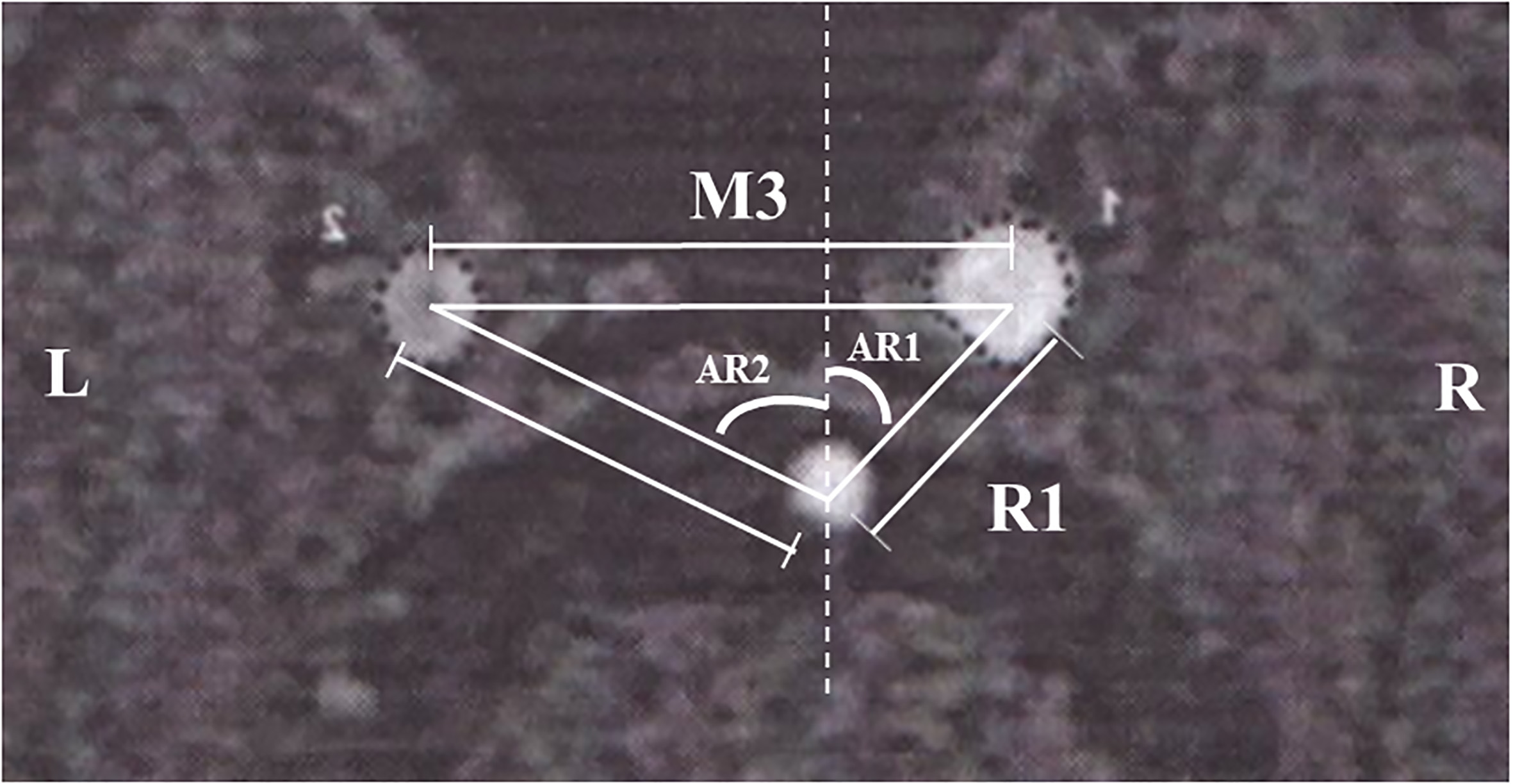 A slice in the transverse plane where the ICA and BA can be clearly distinguished (M3: distance between the right ICA and left ICA [cm], R1: distance between the right ICA and BA [cm], L2: distance between the left ICA and BA [cm], AR1: angle between the right ICA and BA [degree], AR2: angle between the left ICA and BA [degree]).
