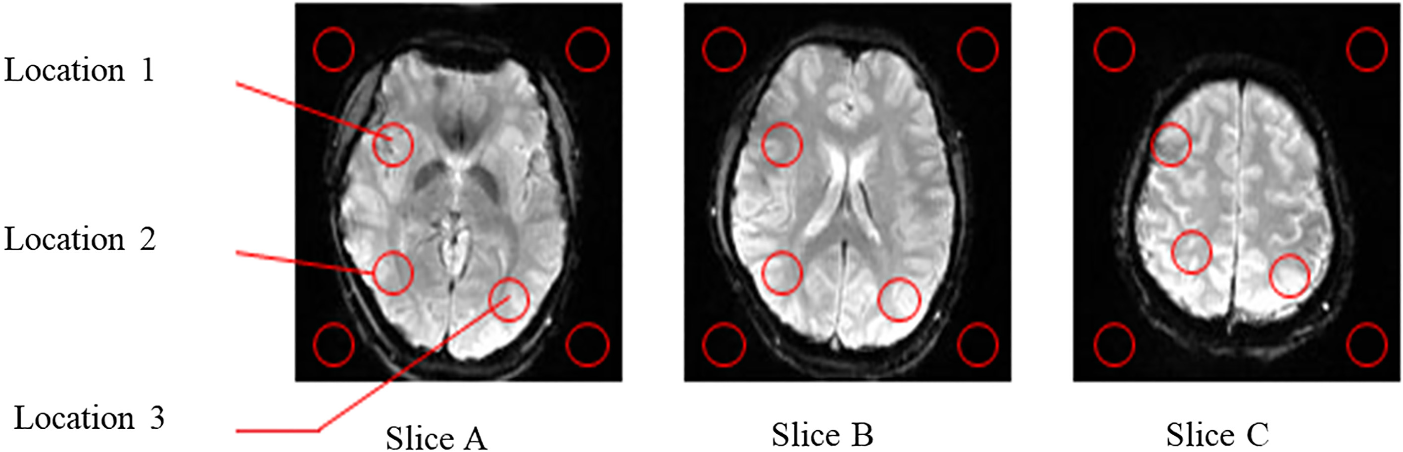 MR brain images of slices A, B, and C.