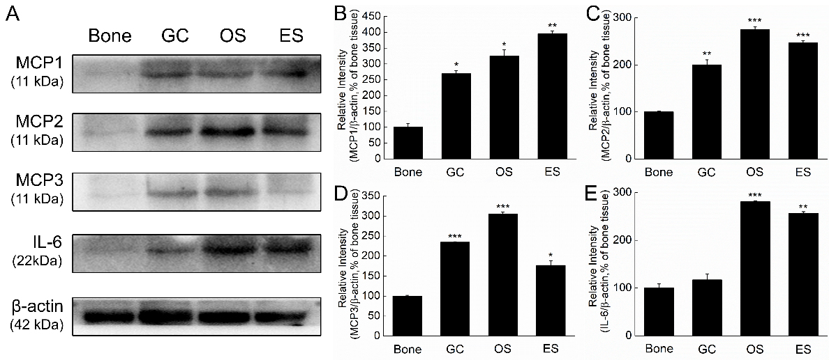 Higher levels of tumor-associated cytokines in GC, OS or ES clinical samples. A. MCP1, MCP2, MCP3 and IL-6 were determined by Western blot. MCP1 (B), MCP2 (C) and MCP3 (D) levels in GC, OS and ES are significantly higher than the bone samples, and IL-6 significantly increased in OS and ES (E). The data are shown as the means ± SD, P*< 0.05, P**< 0.01 and P*⁣**< 0.001 versus the normal bone samples.