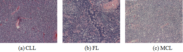 Pathological image samples of three types of lymphoma.