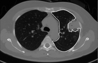 Lung segmentation result is marked by white contour. This lung with a large juxta-pleural tumor is segmented by the traditional method.