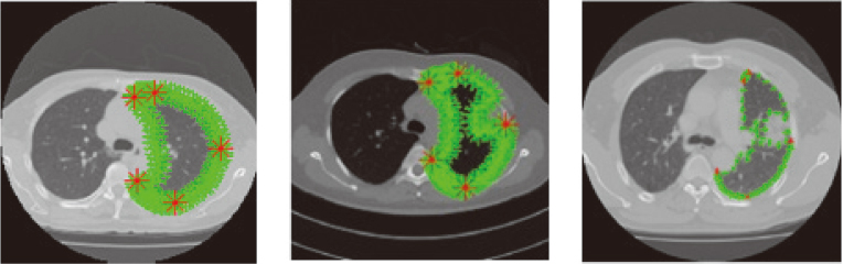 Training samples including noise samples, the five main marking points are red, the marking points are green. (a) marker points in lung contour with no juxta-pleural tumor. (b) and (c) marker points in lung contour with juxta-pleural tumor.