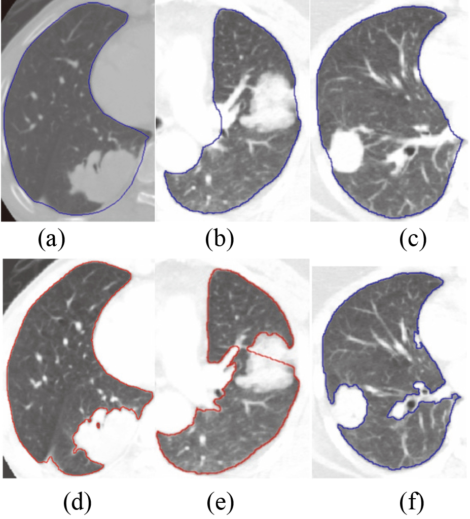 Compares the lung segmentation results with juxta-pleural tumor based on ASM based on PCA and ASM based on RPCA; (a) ∼ (c) the segmentation results of ASM based on RPCA; (d) ∼ (f) to the segmentation results of traditional methods.