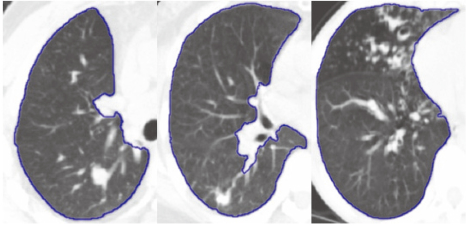 Lung segmentation result with tumor by ASM based on RPCA.