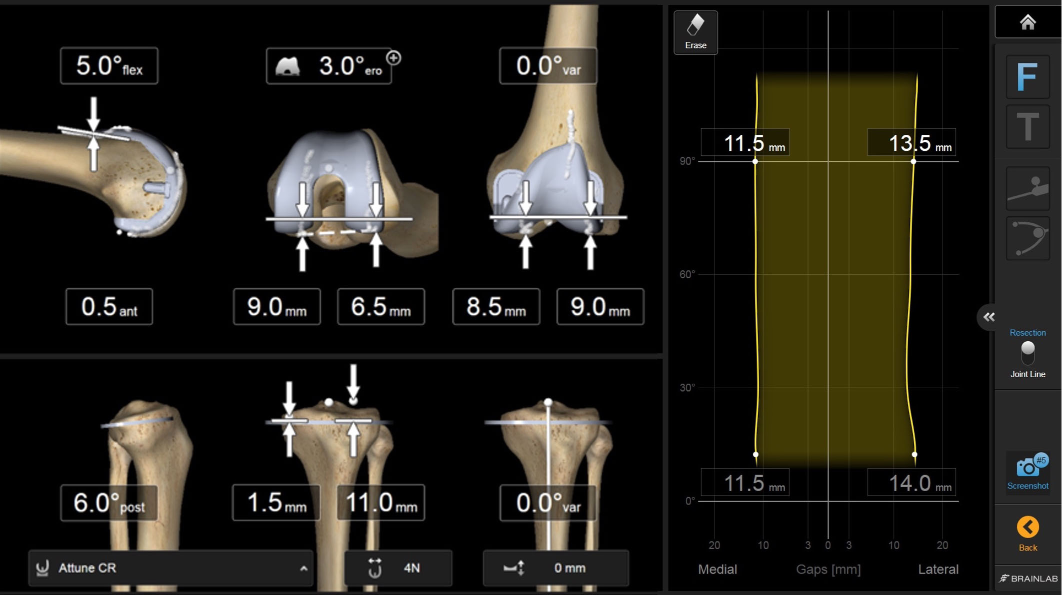 The right screen shows a graph of gaps from full knee extension to full flexion. The lateral gap is shown on the right side, and the medial gap is shown on the right side. The left screen shows the component alignments and estimated widths of bony resection.
