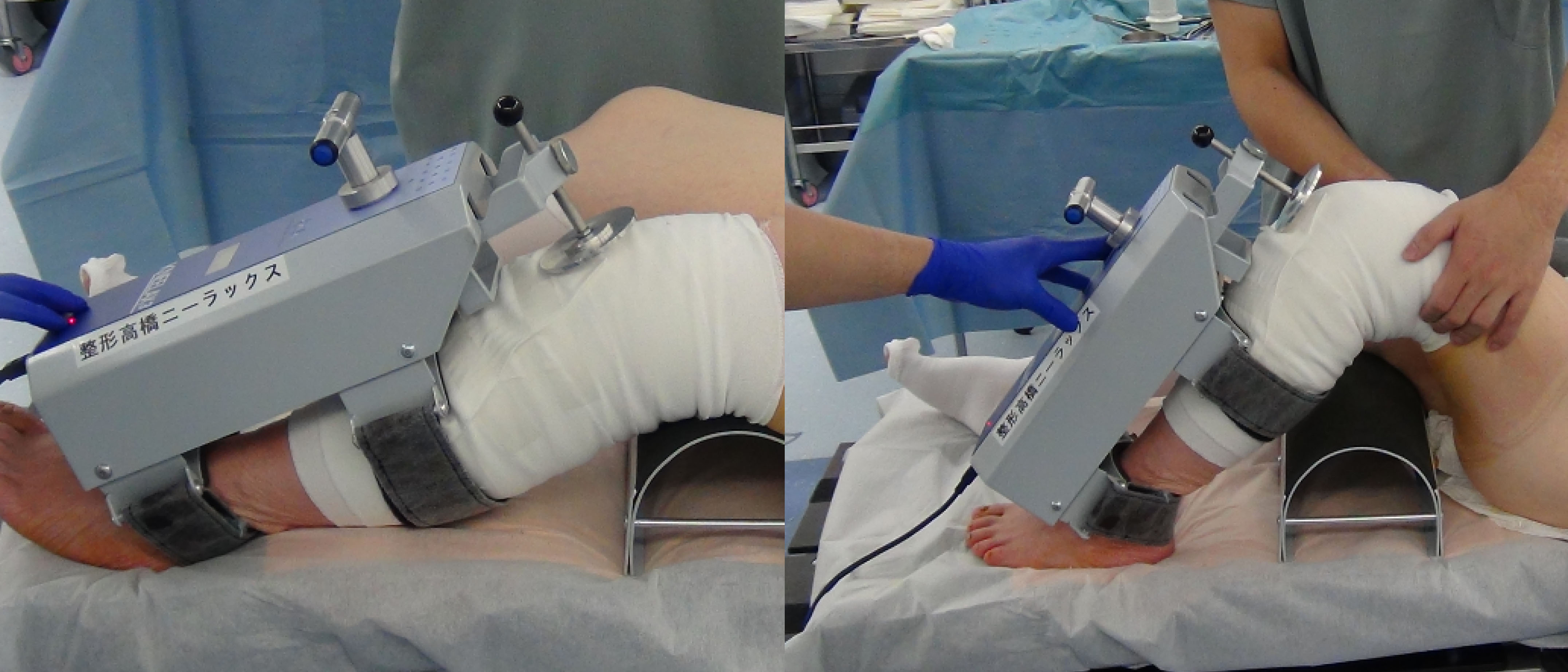 Postoperative knee AP laxity measurements made by using a Kneelax 3 arthrometer at 30∘ and 90∘ of knee flexion.