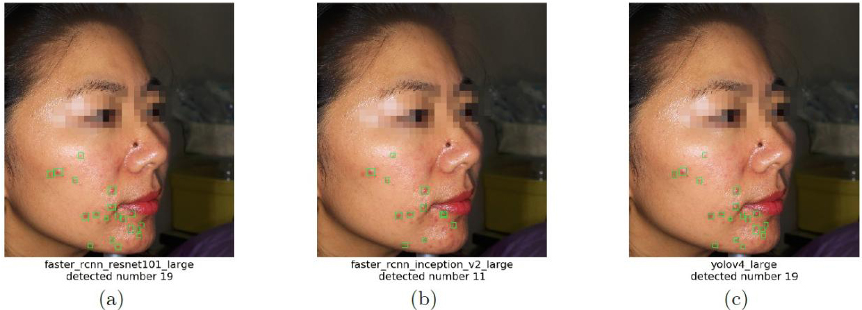 Examples for comparison of performances of the detectors. Acne lesions are located with green boxes. Names of the detectors are under the images, together with the number of acne lesion detected. The ground truth acne lesion number is 17. The bounding boxes and acne lesion number were drawn with score threshold = 0.5.