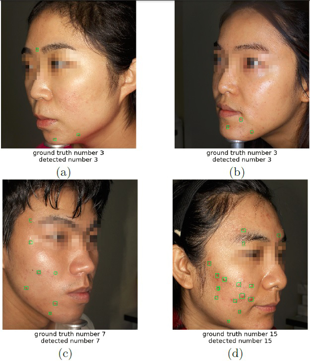 Examples for which detected acne lesion number matches exactly with the ground truth. Acne lesions are located with green boxes. Detections were using faster_rcnn_resnet101_large with threshold = 0.5.