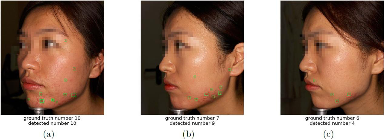 Acne detectors are able to provide numerical evidence for the lowering of facial acne severity. Acne lesions are located with green boxes.