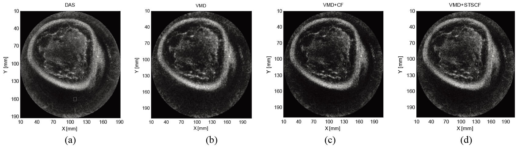 Reconstructed images of female volunteer breast by (a) DAS; (b) VMD; (c) VMD+CF; (d) VMD+STSCF.