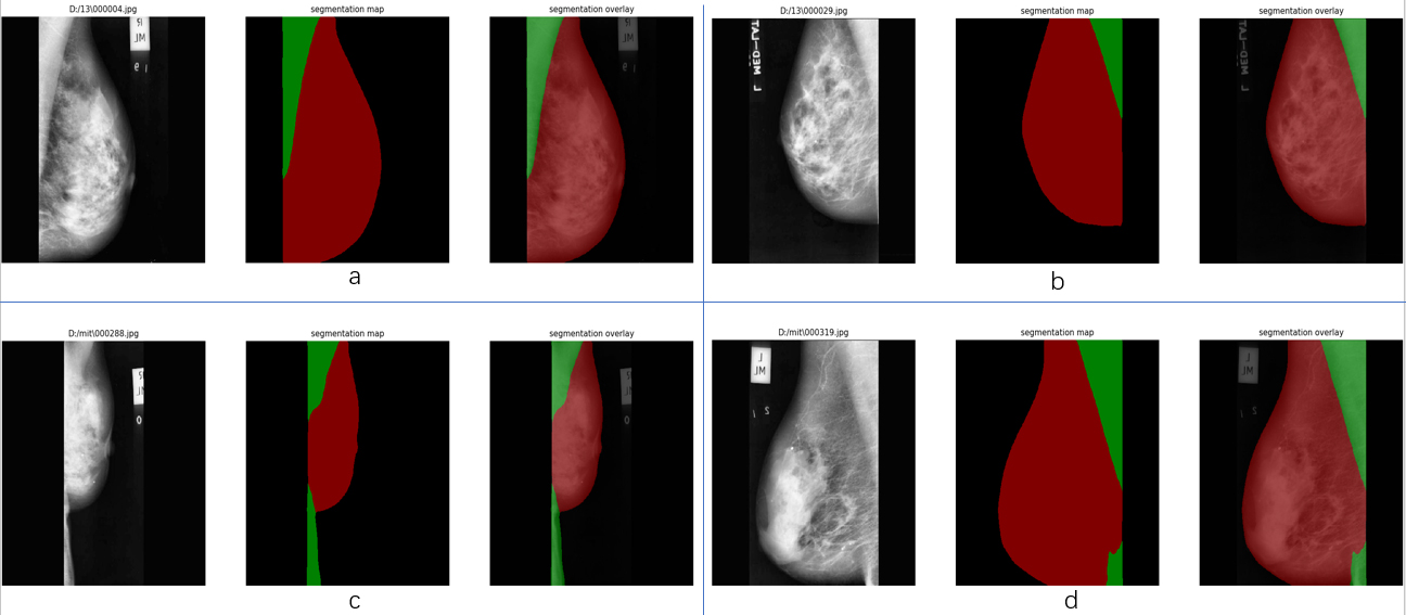 Effect of semantic segmentation on mini-MIAS. Group a and c are the images at right MLO view, group b and d are the images at left MLO view. For each group, the image on the left is the input, the middle is the result image called segmentation map with red label representing breast region and green label representing pectoral muscle region. On the right is the overlay which covers labels to the original image. It can be seen that a lack of contrast between breast and pectoral muscle will lower performance of the model.