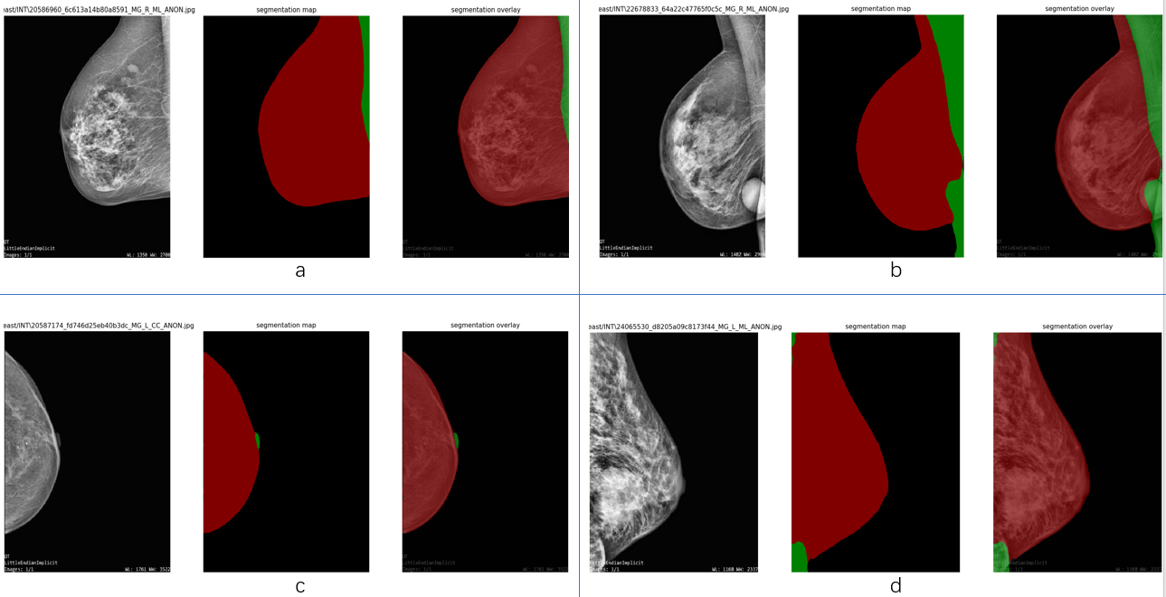 Effect of semantic segmentation on INbreast dataset. Group a and b are at left MLO views, group c is at right CC view, group d is at right MLO view. It can be seen that the pre-processing step has performance limitation in terms of some specific cases.