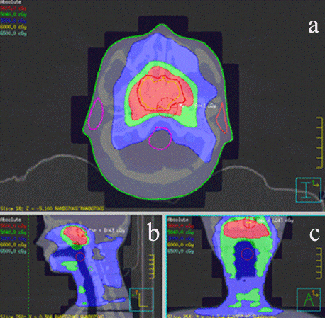 The NPC treatment of for VMAT (a) axial, (b) sagittal, and (c) coronal of 5th section of Rando views of Pinnacle planning system.