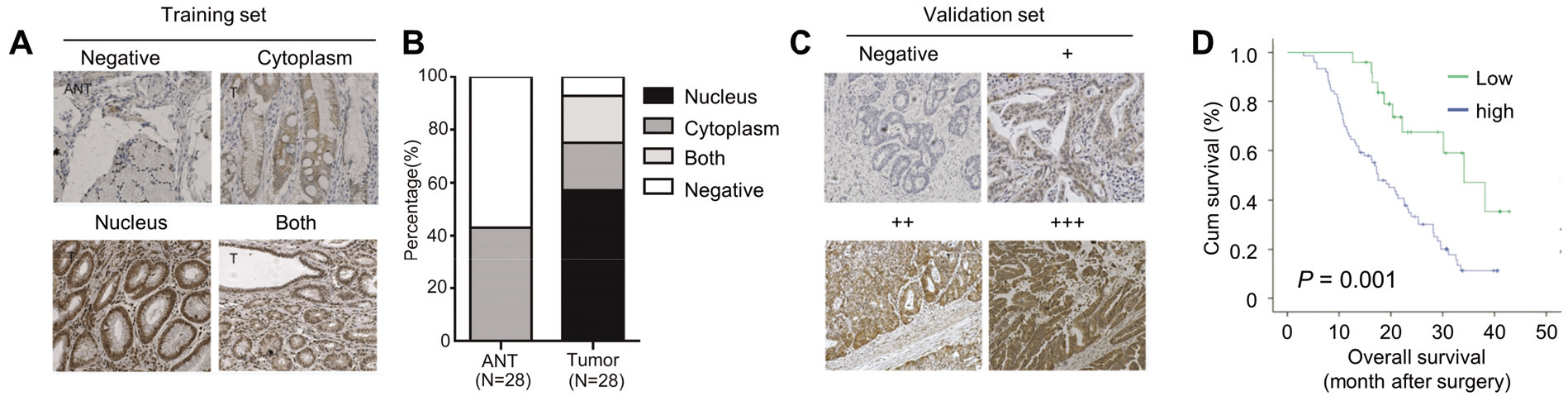 YAP is upregulated in GC tissues and correlates with poor prognosis. x100. (A) Expressions of YAP in gastric cancer and corresponding adjacent non-tumor tissues detected by immunohistochemistry in training set. (B) Subcellular localization of YAP expression in 28 gastric cancer and corresponding adjacent non-tumor tissues. (C) Expressions of YAP in gastric cancer and corresponding adjacent non-tumor tissues detected by immunohistochemistry in validation set. (D) Kaplan-Meier analysis of overall survival time in 28 gastric cancer patients according to YAP expression.