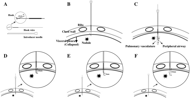 Technical diagram of the CT-guided hook wire positioning technology. (A): Hook wire equipment. (B): Hook wire should not be inserted too shallow, otherwise it is easy to pull out the hook wire when the lung collapses. (C): The hook wire should also not be inserted too deeply; otherwise the possibility of pulmonary vascular or airway damage will increase. (D), (E) and (F): Three-step approach to insert the hook wire and take out the guide needle. (D): Hook wire and guide needle should be inserted no less than 10 mm below the visceral pleural surface. (E): The insertion distance of hook wire should be 5 mm above the tip of guide wire. (F): Guide needle could be unreeved entirely. 
