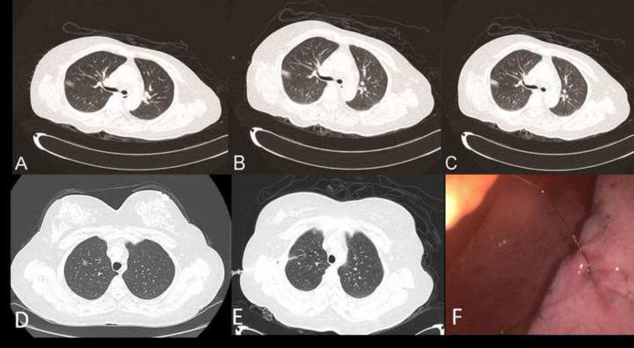 (A, B) Computed tomography scan before and after marking the pulmonary nodule using the hookwire of Case 1. (C) Anchorage of the hookwire in the lung parenchyma in Case 1. (D–E) Computed tomography scan before and after marking the pulmonary nodule using the hookwire in Case 2. (F) Lesion under VATS in Case 2. VATS, video-assisted thoracic surgery. 