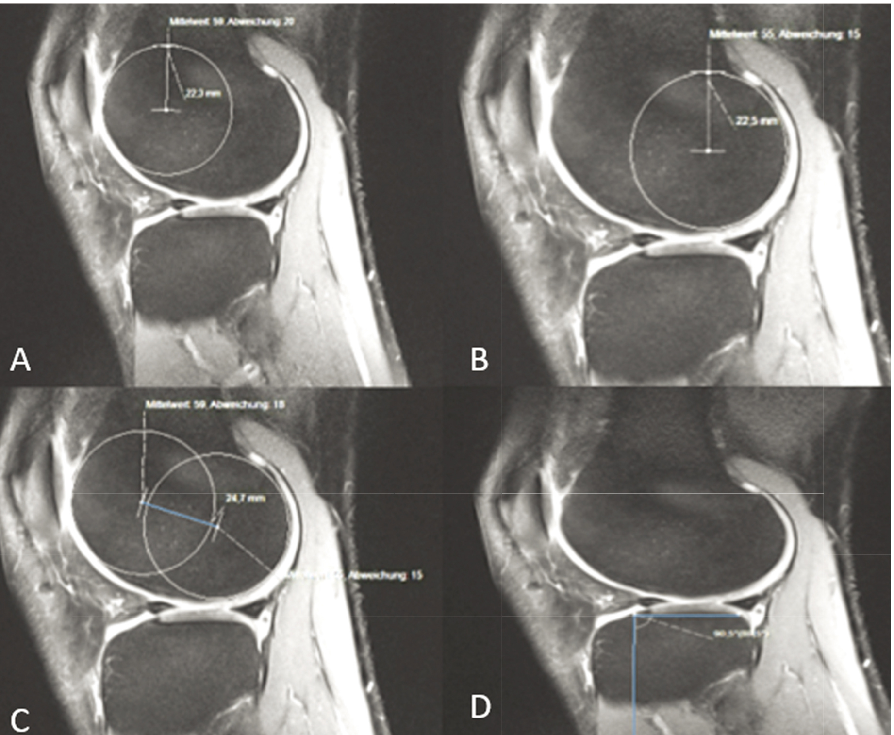 Variables 5–7 and 11 are shown in section A–D. A: Variable 5 (extension facet of the lateral femoral condyle). B: Variable 6 (flexion facet of the lateral femoral condyle). C: Variable 7 (distance between the circle-centers of the lateral femoral condyle). D: Variable 11 (angle between tibial plateau and tibial shaft lateral). Determination of the extension and flexion facet of the medial femoral condyle as well as the distance between the circle-centers was performed according to the demonstrated technique on the lateral side. Same applies to the determination of the medial tibial slope.
