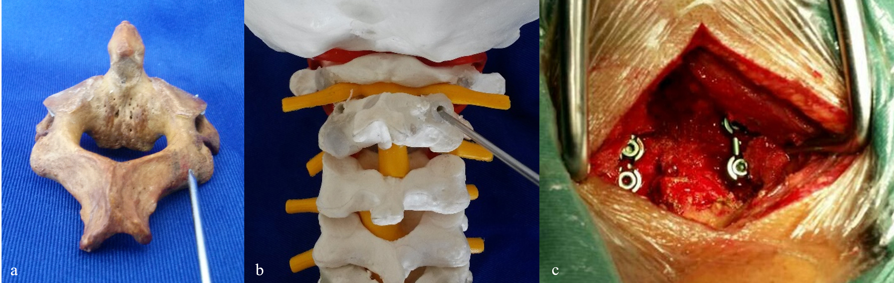 A, B: The entry point and direction of the C2 pedicle screw in the specimen and 3D printed model. C: Intraoperative placement of the C1–2 pedicle screws and connecting rods.