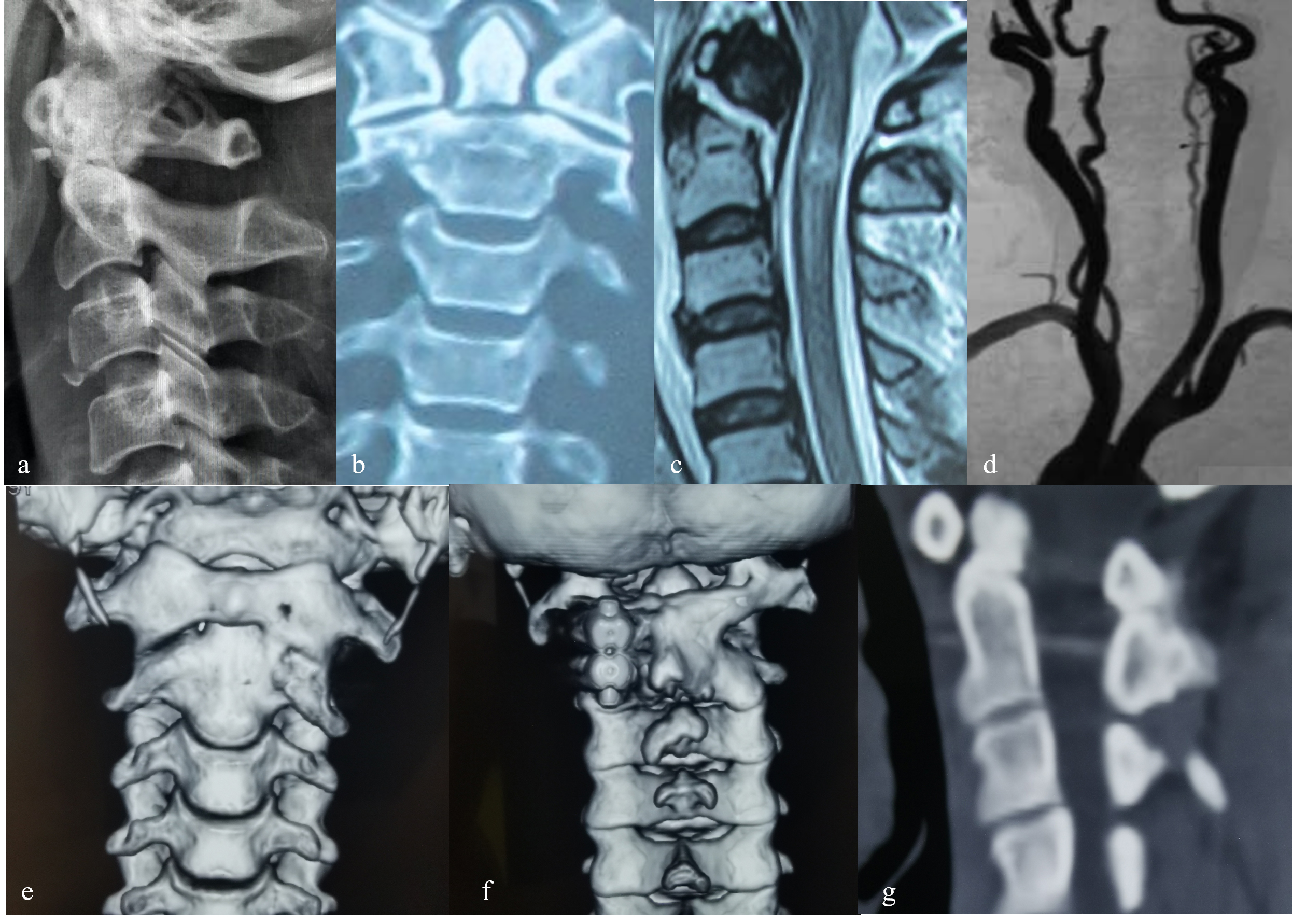 Female, 47 years old, odontoid fracture caused by traffic injury leading to cervical spinal cord injury and quadriplegia in the unilateral group. A, B: Preoperative lateral X-ray film and coronal CT showed Anderson type II odontoid fracture. C: Preoperative MRI T2WI showed odontoid fracture and diffuse intramedullary hyperintensity at C2 level. D: Preoperative CTA showed obvious stenosis of the vertebral artery on the right side. E: The anteroposterior X-ray film on the 2nd day after surgery showed the C1–2 pedicle screws and rods on the right side were in good position. F: The sagittal CT at 6 months after surgery showed the bone graft between the C1 posterior arch and C2 spinous process was clear and fused. G: The axial CT at 6 months after surgery showed the pedicle screw on the right side was in good position without loosening or rupture.