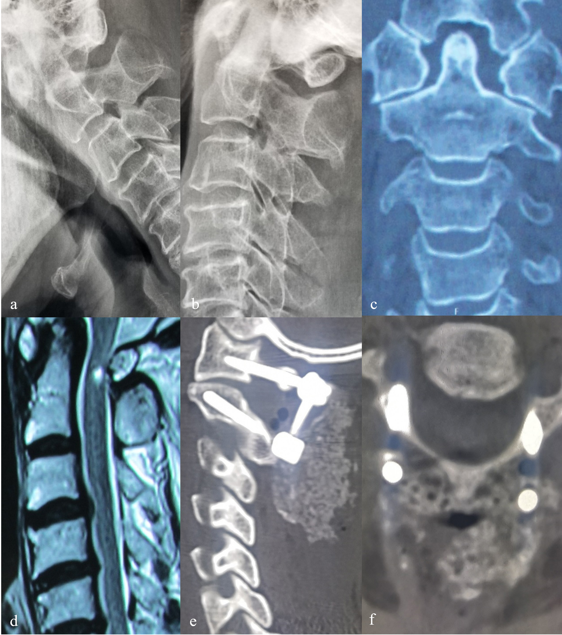 Male, 68 years old, atlantoaxial dislocation caused by high-fall injury leading to a cervical spinal cord injury and quadriplegia in the bilateral group. A–C: Preoperative dynamic X-ray film and coronal CT showed atlantoaxial dislocation. D: Preoperative MRI T2WI showed intramedullary hyperintensity at the odontoid level. E, F: The sagittal and axial CT at 6 months after surgery showed the implants were in a good position, the bone mass in the bone graft area was sufficient, and the osseous fusion was observed.