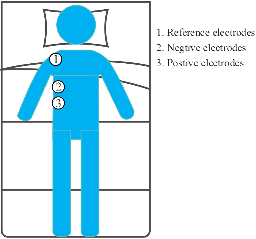 Position of electrode for SEMGdi signal acquisition.