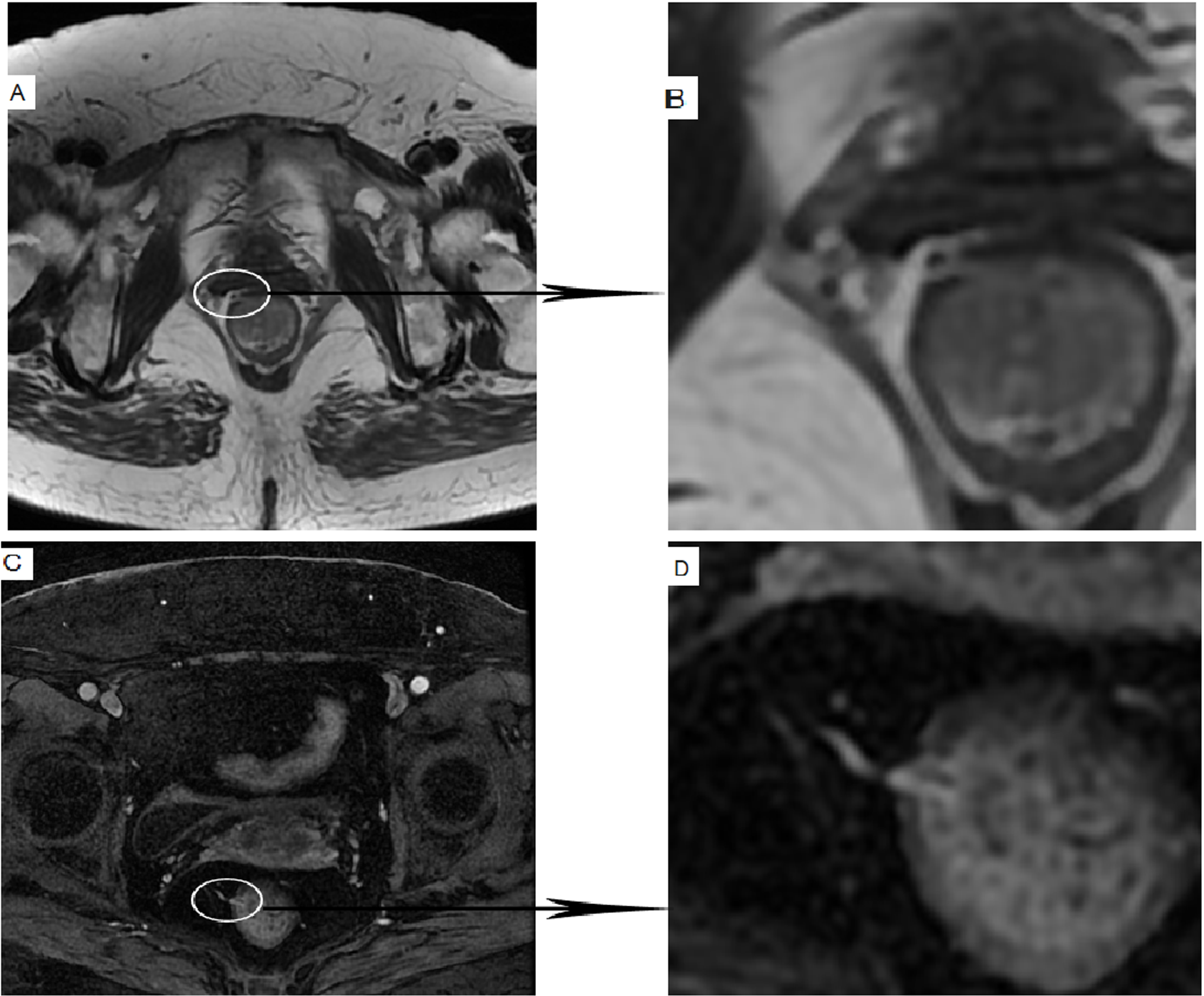 MR image after neoadjuvant therapy. A 64-year-old female presented with hematochezia for 3 months. Postoperative pathological stage was T2. Figure 1B and D are local enlarged images of Fig. 1A and C, respectively. Figure 1A–B: The transverse axial HR-T2WI showed uneven thickening of the posterior rectal wall, clear serosa surface, and strip-like high signal in the right anterior wall. According to the HR-T2WI image, the staging was mrT3. Figure 1C–D: DCE-MR showed a vascular shadow in the right anterior wall of the rectum and a slight enhancement of the thickened posterior wall of the rectum. According to the DCE-MR image, the staging was mrT2.