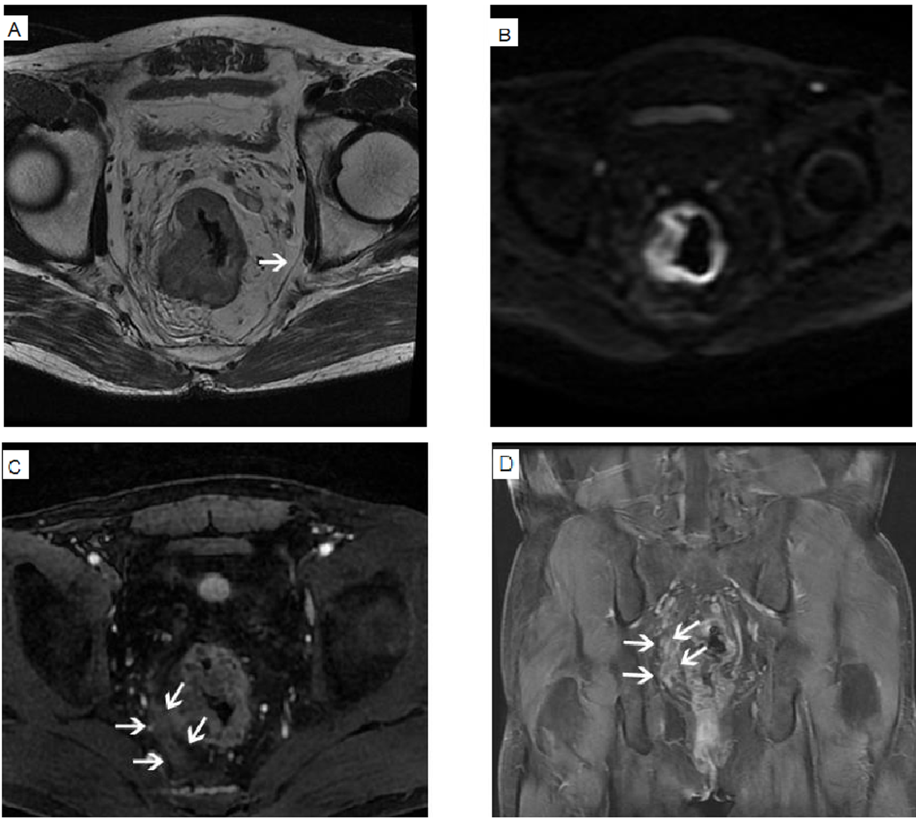 MR images after neoadjuvant therapy. A 71-year-old male presented with bloody and emaciation stool for half a year. Pathological examination revealed invasion of mesorectal fascia. Figure 2A axial T2WI showed that the rectal wall was unevenly thickened, and the limitation was prominent outside the contour of the intestinal wall. The T2 signal of the thickened intestinal wall was slightly higher, and the internal spotted higher T2 signal was visible. The mesorectal fascia (white arrow) was seen around it. According to the HR-T2WI image, the tumor did not invade the mesorectal fascia. Figure 2B axial DWI showed increased signal in the thickened rectal wall. According to HR-T2WI combined with DWI, the tumor did not invade the mesorectal fascia. Figure 2C–D axial and coronal DCE-MR showed that the thickened rectal wall was significantly thickened and significantly enhanced. The right side of the rectum was accompanied by patchy enhancement. The enhancement mode was consistent with the main body of the tumor. Combined with HR-T2 WI, it was suggested that the tumor invaded the mesorectal fascia.
