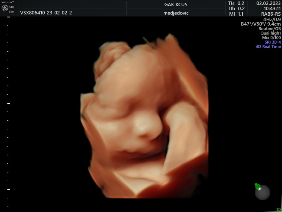 3D US image of 28 weeks baby, hand-to-face movement.