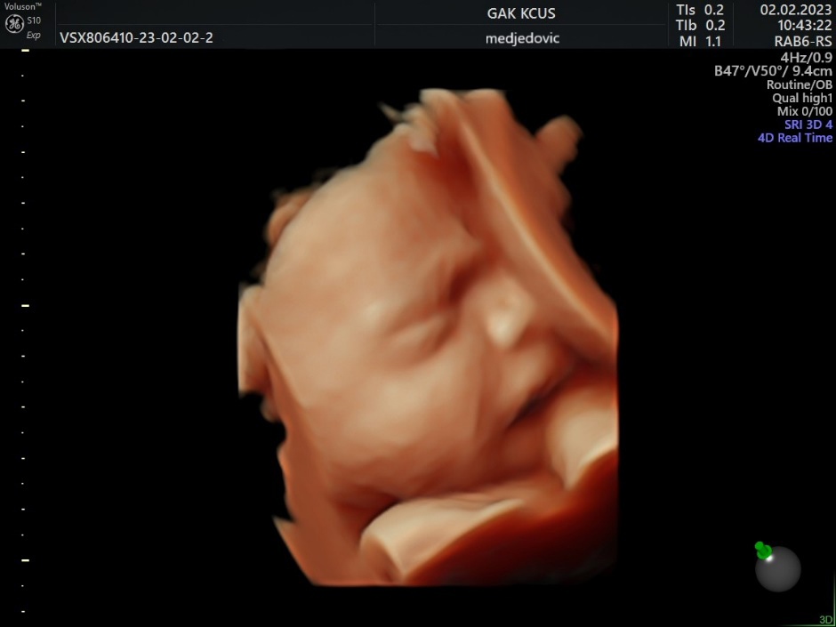 3D US image of 28 weeks baby, scowling.