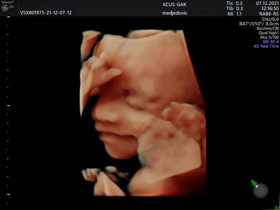 3D US image of 28 weeks baby, smiling.