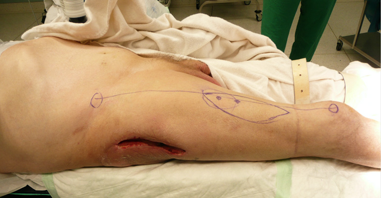 Peroperative markings.