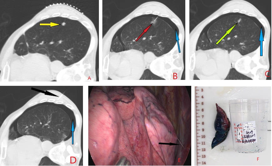 Depicts the case of a single patient with a nodule in the left lower lobe (highlighted by yellow arrows) in the right lateral decubitus position. Puncture was performed using a breast localization needle: A. Pre-puncture localization of the nodule.B. After adjusting the angle of the puncture needle, it was inserted into the lung, revealing alveolar hemorrhage (indicated by red arrows) and a small pneumothorax (indicated by blue arrows). C. Release of the hook-wire, with the distal end anchored (indicated by green arrows) within 1 cm of the lesion. D. Post-release scan confirming the position of the localization needle and assessing lung complications. The steel wire tail (indicated by black arrows) was then externally ligated.The difficulty in securing the metal tail wire after hook-wire anchoring may lead to increased friction with the chest wall, resulting in a higher likelihood of secondary pneumothorax and alveolar hemorrhage, contributing to a less favorable patient experience.E and F: Surgical field views observing the condition of the hook-wire and postoperative excised pathological specimens, with the specimens removed for further examination after detaching the localization needle. 
