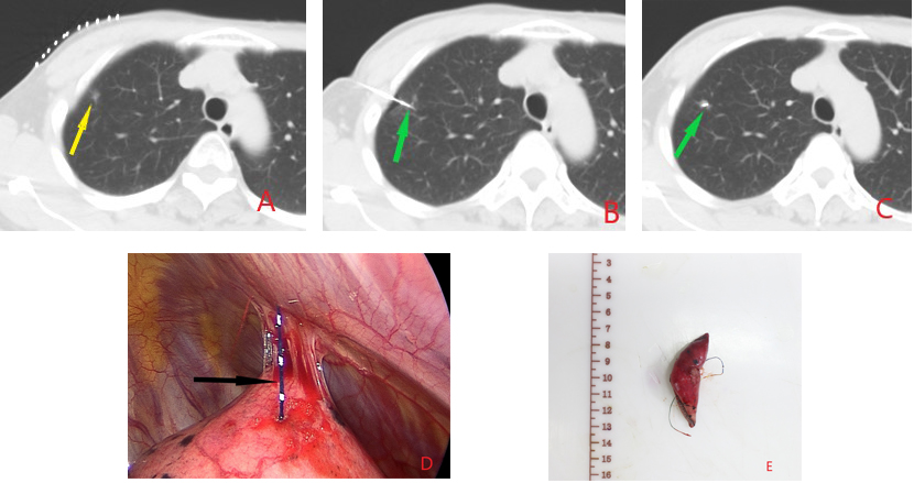 Illustrates the case of the same patient with a nodule in the right upper lobe (highlighted by yellow arrows) in the supine position. Puncture was performed using a disposable pulmonary nodule puncture needle: A. Pre-puncture localization of the nodule. B. After adjusting the angle of the puncture needle(indicated by green arrows), it was inserted into the lung. C. Post-release scan confirming the position of the localization needle (indicated by green arrows) and assessing lung complications. The steel wire tail was then externally ligated. No alveolar hemorrhage or pneumothorax was observed within the lung, and the tail wire was easily secured after hook-wire anchoring, providing a comfortable experience for the patient. D and F. Surgical field views observing the condition of the hook-wire (indicated by black arrows) and postoperative excised pathological specimens. The specimens were sent for examination, carrying the hook-wire along for further analysis.
