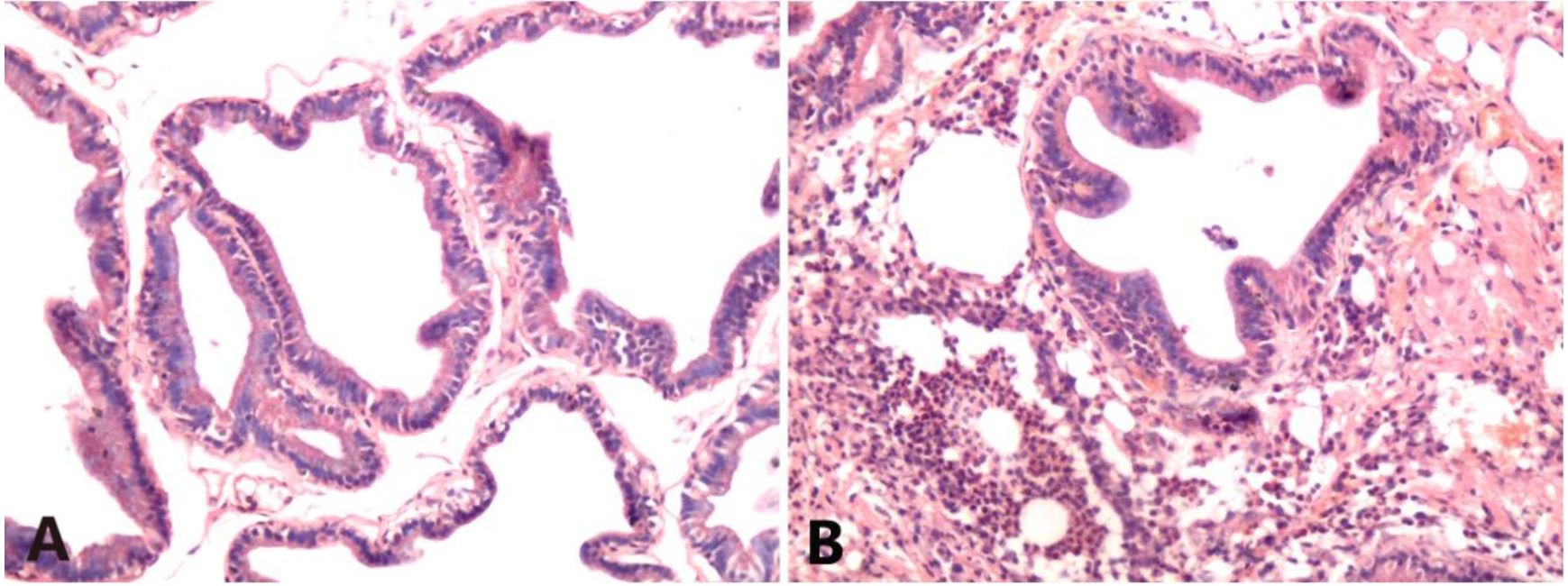 HE staining of rat prostate tissues (HE×200). A. Sham operation group: There was no vasodilation or vasocongestion, interstitial dilation or edema, and was devoid of any interstitial inflammatory cell infiltration; B. Modeling group after 7 d: There was severe vasodilation, and blood vessel burst was observed; Severe perivascular neutrophilic and lymphocytic infiltration was noted.
