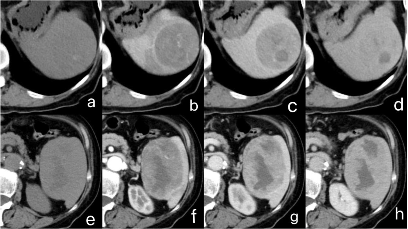 CT images of EBV-positive inflammatory FDCS. (a) and (e) represent non-contrast images, revealing two cystic-solid soft tissue masses. (b)–(d) and (f)–(h) correspond to contrast-enhanced arterial, venous, and delayed phase images, illustrating moderately uneven enhancement along the edges and within the solid components of the masses. Patchy non-enhanced areas are observed internally.