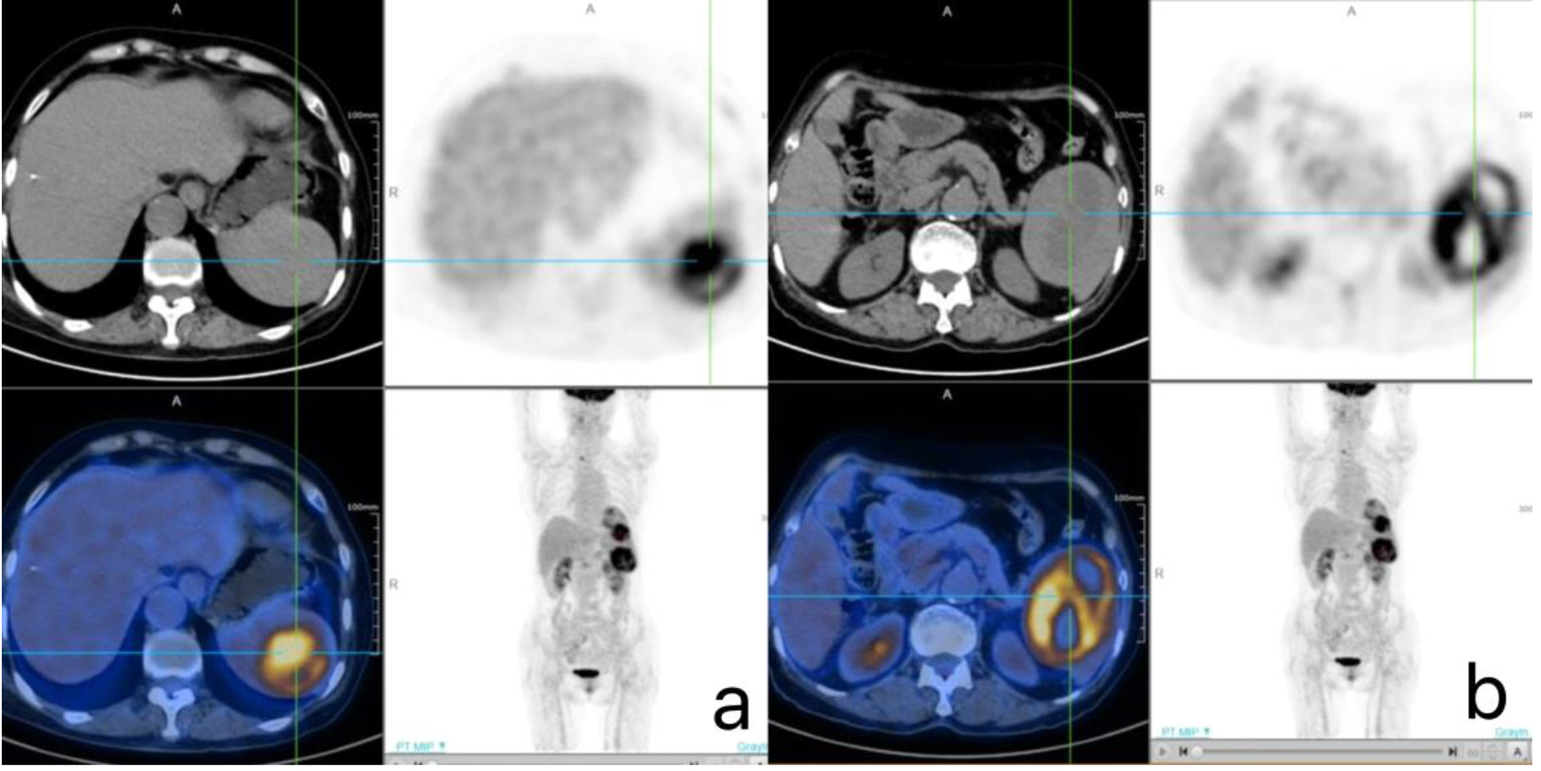 PET/CT images of EBV-positive inflammatory FDCS, which reveal increased metabolic activity within the masses. (a) The tumor SUV is 10.8, (b) The tumor SUV is 8.3.