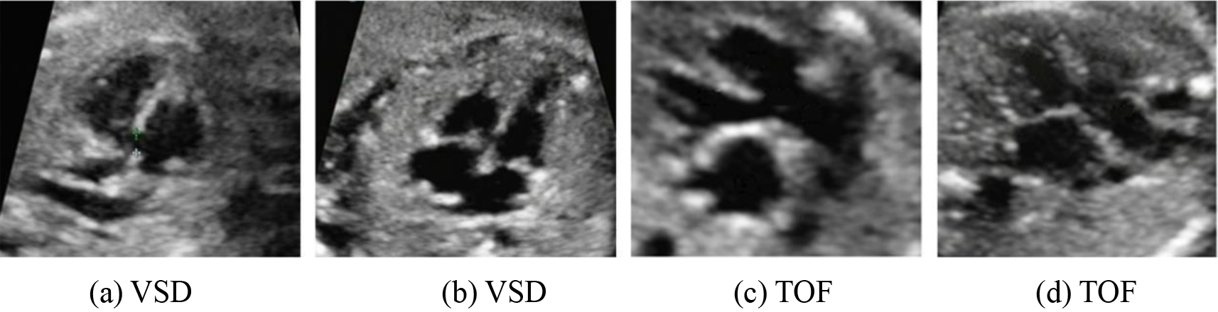 Fetal VSD and TOF images.