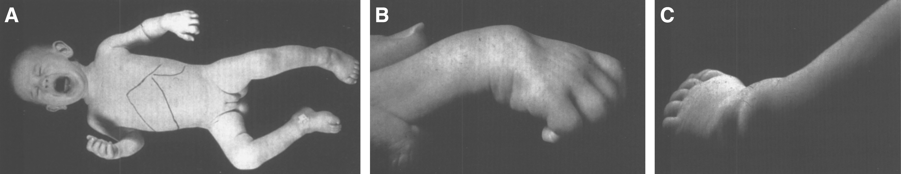 Farber disease. (A) Child with multiple skin nodules. (B) Large nodules on the wrist and (C) on the ankle. (Courtesy of Dr. Steven Qualman.).