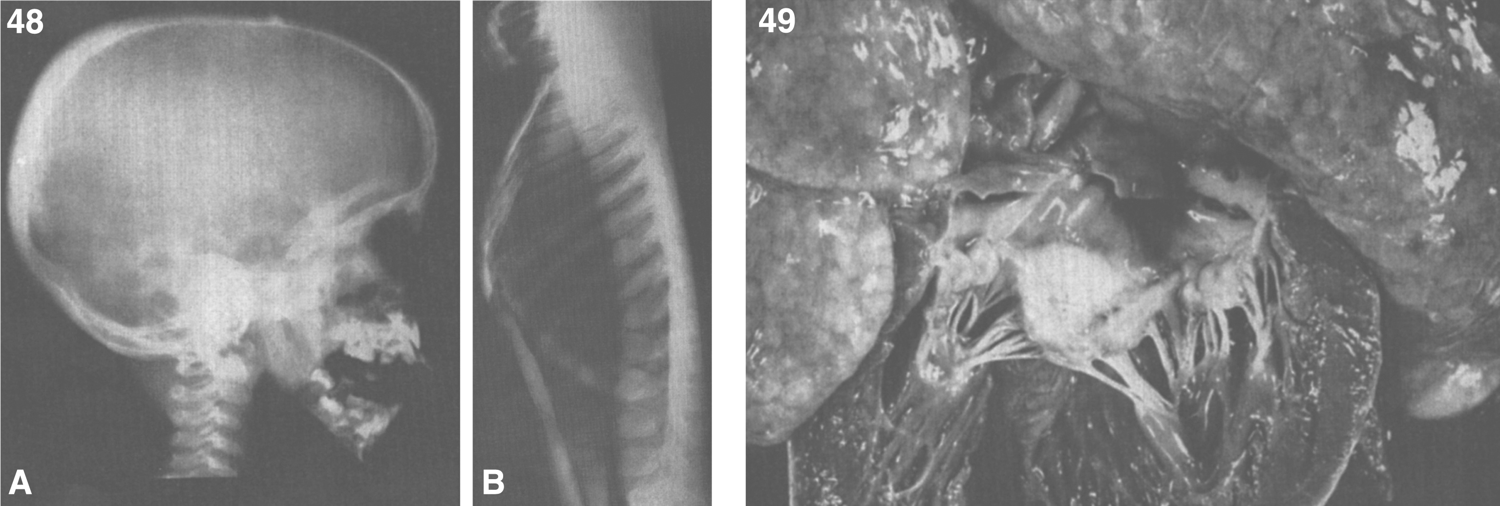 GM1 gangliosidosis type II. Postmortem X-ray. (A) Changes of dysostosis multiplex in skull. (B) Lateral projection of vertebrae that shows mild generalized platyspondyly of cervical vertebrae and tear-drop deformity of vertebrae; (49) GM1 gangliosidosis type II. Gross appearance of heart opened through the left ventricle. The mitral valve leaflets are markedly deformed and thickended.